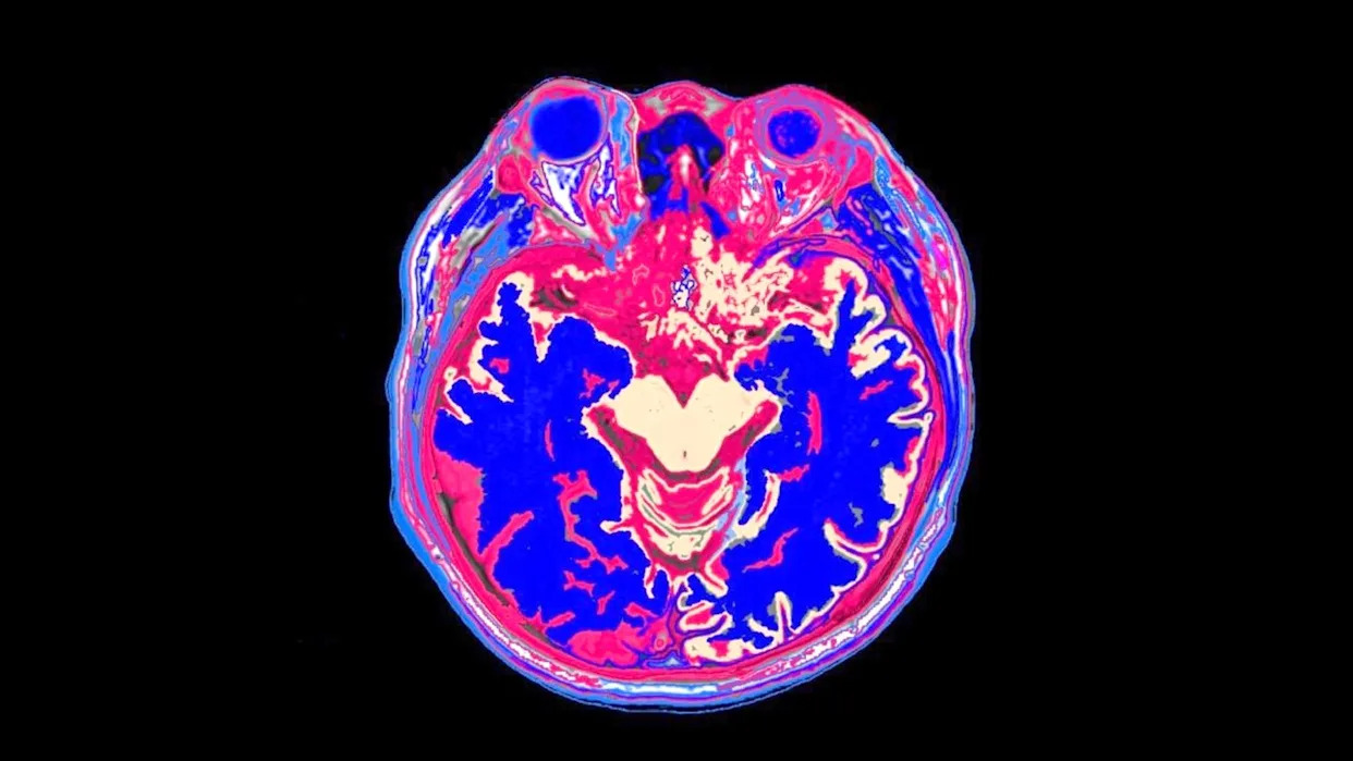 heal-brain-damage-stroke1 سکته مغزی